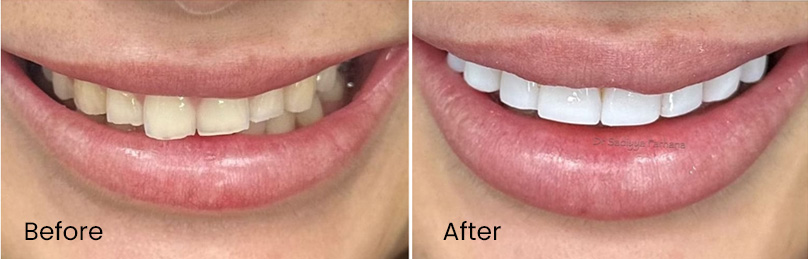 Composite Bonding