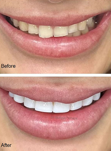Composite Bonding